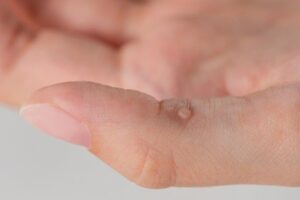 Myths vs Facts: What Causes Warts and How to Treat Them This Summer